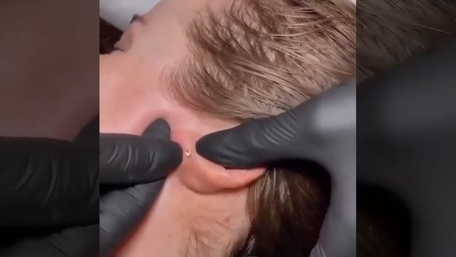 Чистка мочки уха от угрей #акне #прыщ #угри