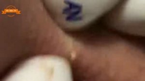 Удаление прыщей с носа и щек Spa G #046