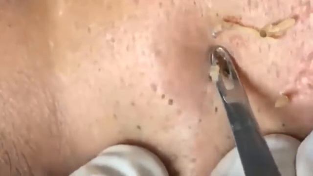 Прыщи / Огромные прыщи / Релакс с акне / Выдавливание пр