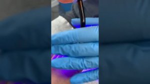 Применение жидкой тампонады "Темпо"