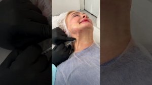 Блокада ботоксом платизмы.