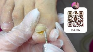 ГРИБОК НОГТЕЙ | ПОДОЛОГИЯ |педикюр