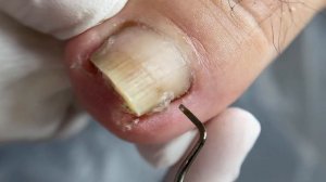 Установка титановой нити на деформированный ноготь #п