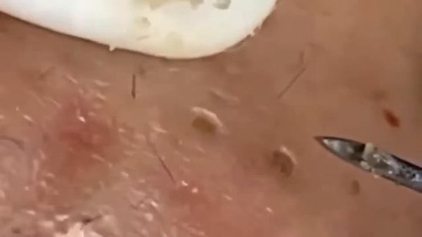 Прыщи / Огромные прыщи / Релакс с акне / Выдавливание пр