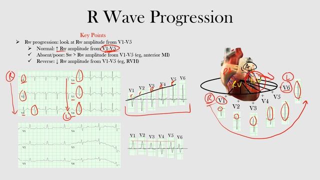 31.R Wave Progression смотреть онлайн