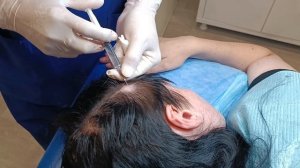 Удаление 4 жировиков (атером) на голове. Removal of 4 cysts on the h