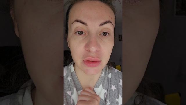 Мезотерапия препаратом Filorga #Filorga #filorga #mezoterapi #mesoterapia