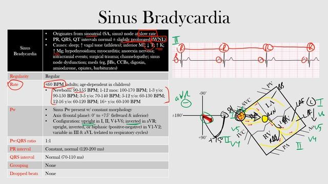 35.Sinus Bradycardia смотреть онлайн