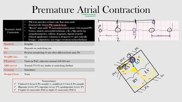 39.Premature Atrial Contraction смотреть онлайн