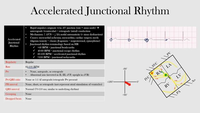 48.Accelerated Junctional Rhythm смотреть онлайн