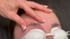 Удаление татуажа бровей