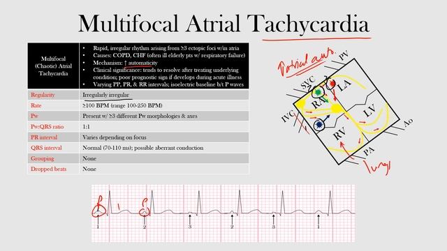 42.Multifocal Atrial Tachycardia смотреть онлайн