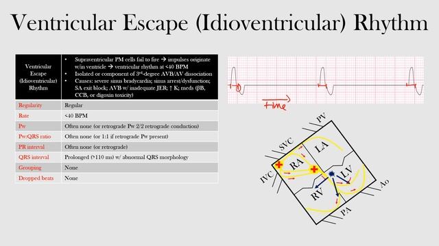 55.Ventricular Escape (Idioventricular) Rhythm смотреть онлайн
