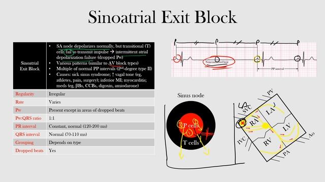 38.Sinoatrial Exit Block смотреть онлайн