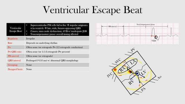 54.Ventricular Escape Beat смотреть онлайн