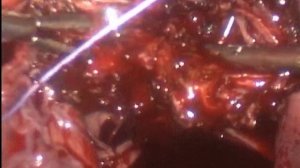 Миома матки больших размеров. Лапароскопия, удаление ?