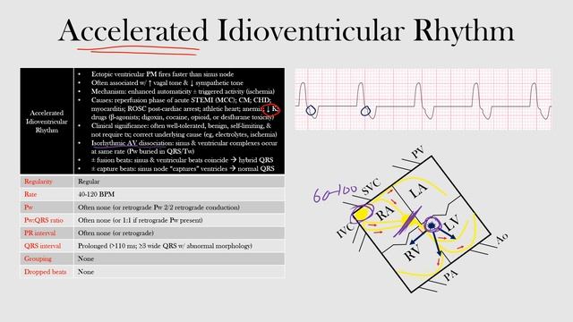 56.Accelerated Idioventricular Rhythm смотреть онлайн