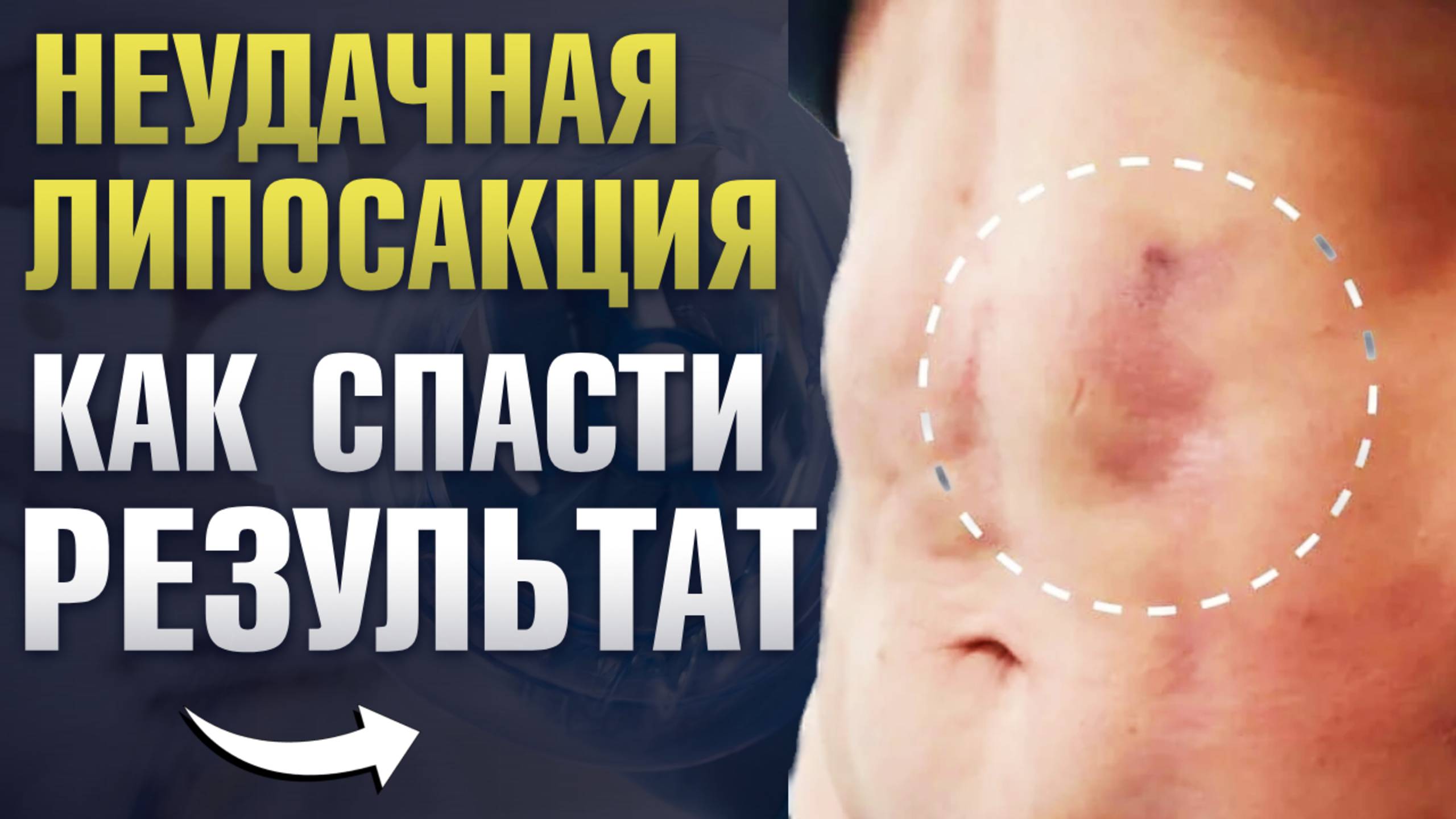 Неровности и бугры после липосакции: что делать? / Осложнения после липосакции