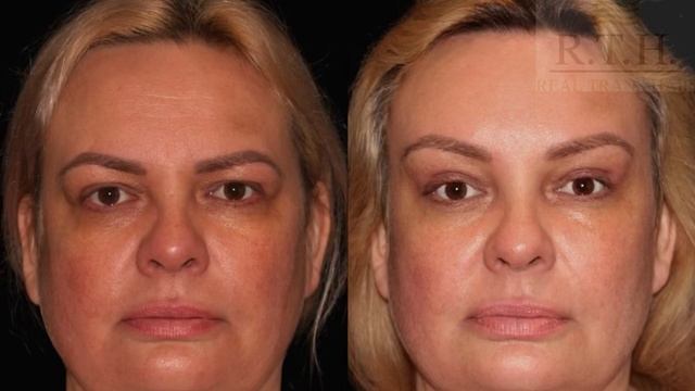 Что такое коронарная подтяжка бровей? смотреть онлайн