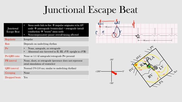 46.Junctional Escape Beat смотреть онлайн