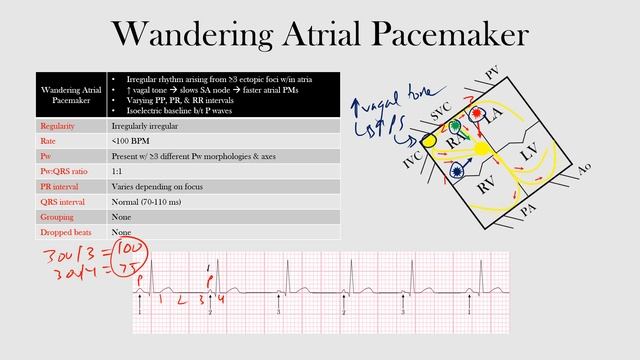 41.Wandering Atrial Pacemaker смотреть онлайн