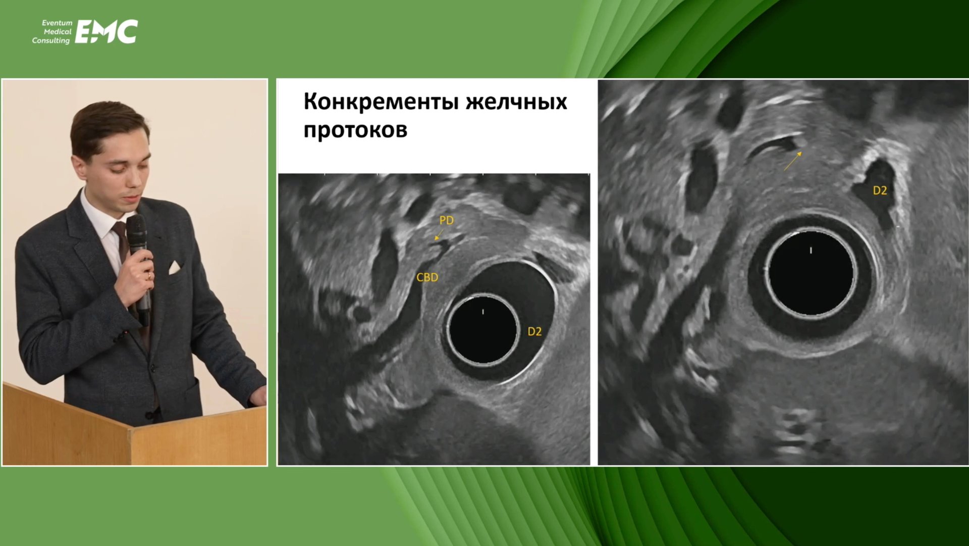 1 Теплов ВО Эндоскопическая диагностика и опер. вмешательства в панкреатобилиарной области у детей