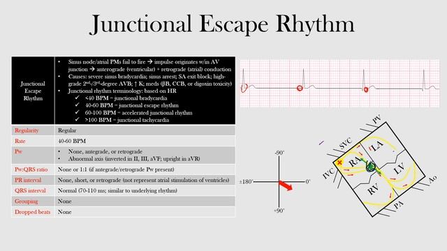 47.Junctional Escape Rhythm смотреть онлайн