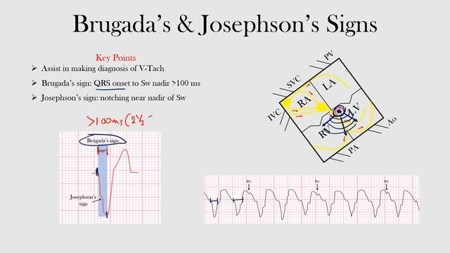 58.Brugada's & Josephson's Signs смотреть онлайн