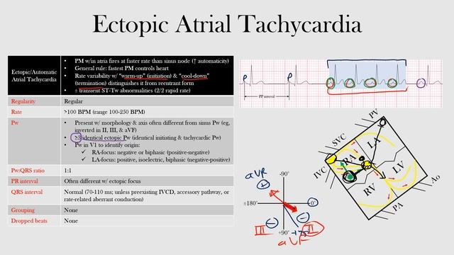 40.Ectopic Atrial Tachycardia смотреть онлайн