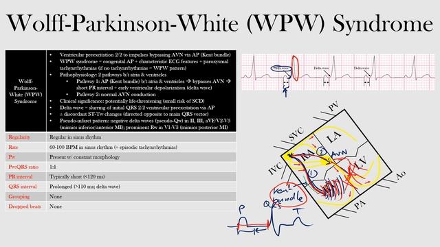 50.Wolff-Parkinson-White (WPW) Syndrome смотреть онлайн
