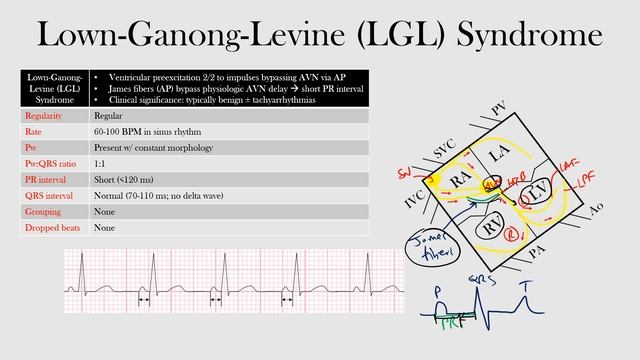 51.Lown-Ganong-Levine (LGL) Syndrome смотреть онлайн