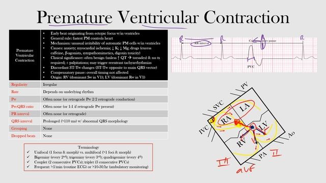 53.Premature Ventricular Contraction смотреть онлайн