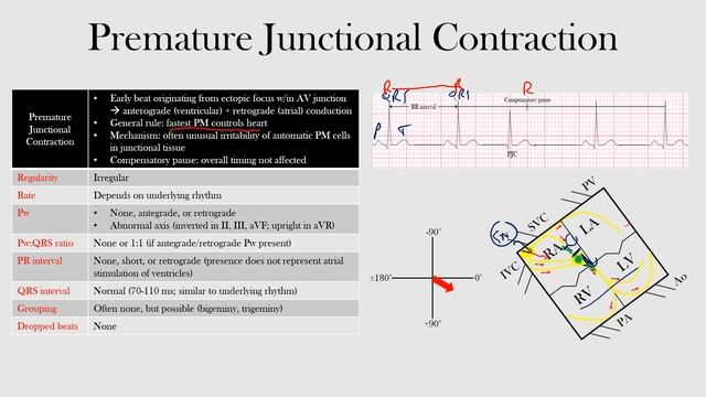 45.Premature Junctional Contraction смотреть онлайн