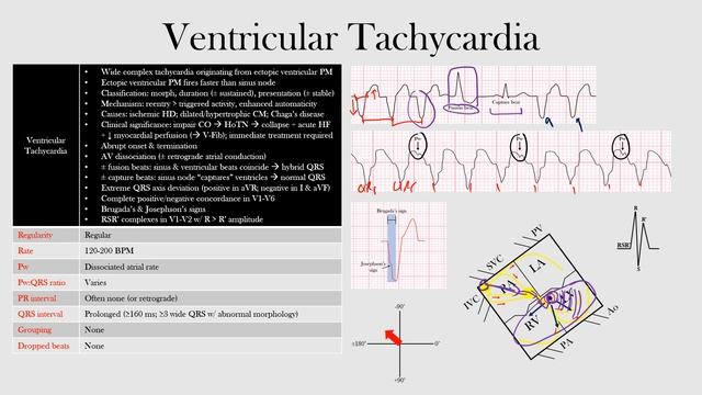 59.Ventricular Tachycardia смотреть онлайн