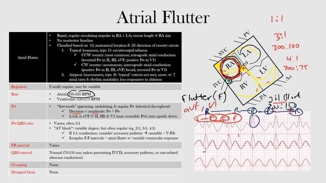 43.Atrial Flutter смотреть онлайн