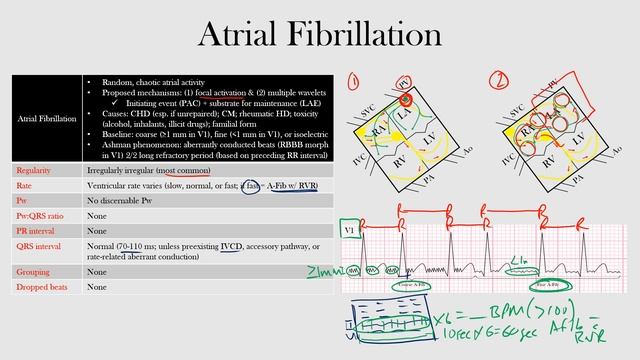 44.Atrial Fibrillation смотреть онлайн