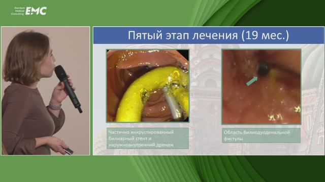 1 Козлова ПС Возможности рентген-эндоскопических вмешательств в коррекции свежих повреждение ЖВП