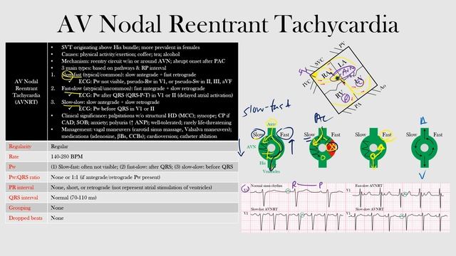 49.AV Nodal Reentrant Tachycardia смотреть онлайн