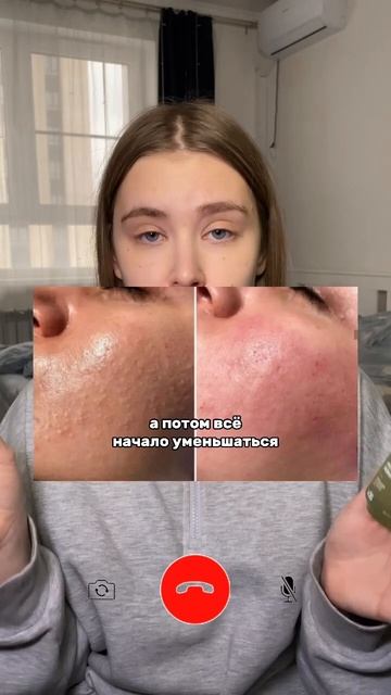 Что взять от прыщей? Артикулы на сыворотки: от акне- 14205 смотреть онлайн