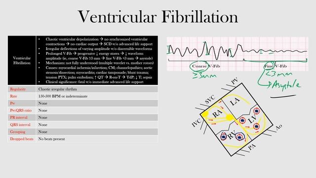63.Ventricular Fibrillation смотреть онлайн