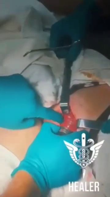 Медицинские заметки. СНАРЯД В БЕДРЕ БОЙЦА ВДВ РФ. смотреть онлайн