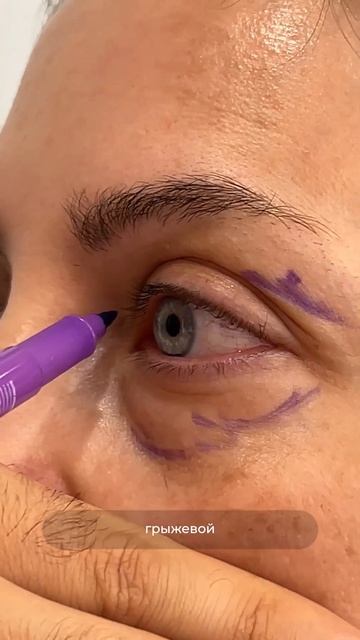 КРУГОВАЯ БЛЕФАРОПЛАСТИКА. Доктор Карапетян смотреть онлайн