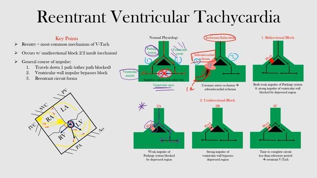 60.Reentrant Ventricular Tachycardia смотреть онлайн