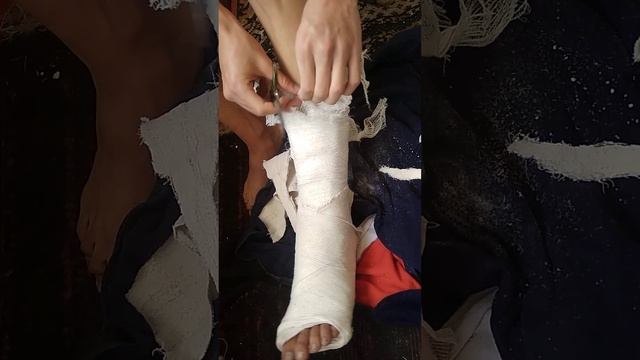 как снять гипс смотреть онлайн