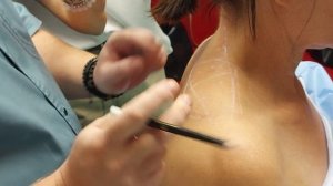 Ботулинотерапия. Трапициевидная мышца.