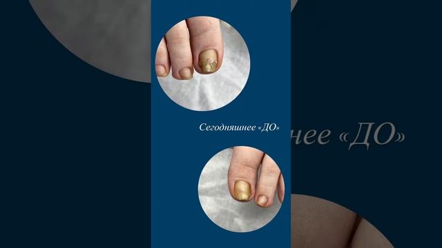 Работа подолога.Коррекция ногтей.#подолог#подология