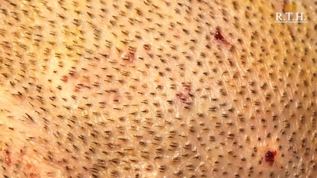 Почему важно использовать современные панчи  для пересадки волос❓ смотреть онлайн