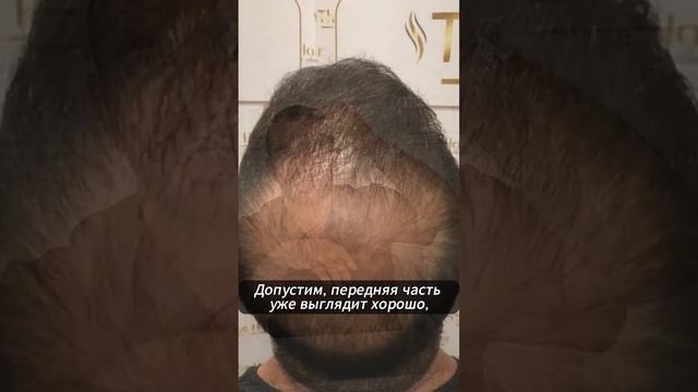 Почему нужно проводить еще раз операцию по пересадке ?