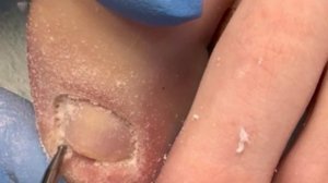 Почему ноготь не растет? Куда он растет? Как вернуть но