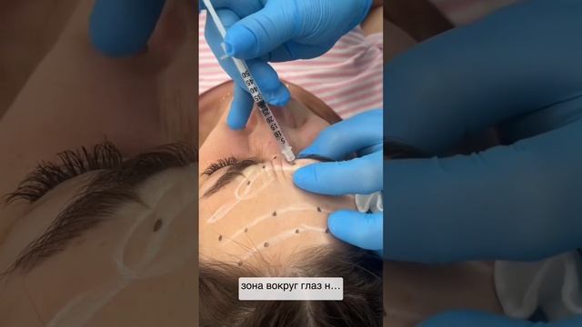 Botox . Ботулинотерапия верхней части лица. Техника докт смотреть онлайн